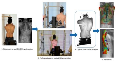 3D scanning for scoliosis diagnistics_Workflow